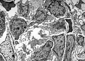 M,73y. | bone marrow - hairy cell leukemia